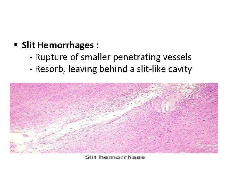 § Slit Hemorrhages : - Rupture of smaller penetrating vessels - Resorb, leaving behind