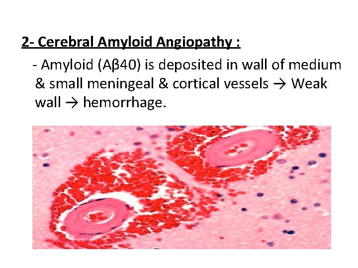 2 - Cerebral Amyloid Angiopathy : - Amyloid (Aβ 40) is deposited in wall