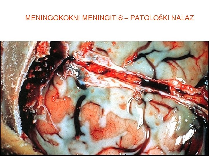 MENINGOKOKNI MENINGITIS – PATOLOšKI NALAZ 