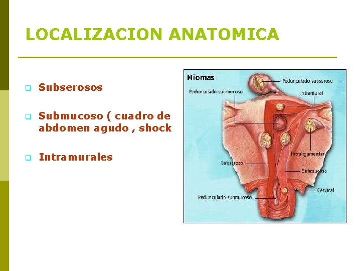 LOCALIZACION ANATOMICA q Subserosos q Submucoso ( cuadro de abdomen agudo , shock q