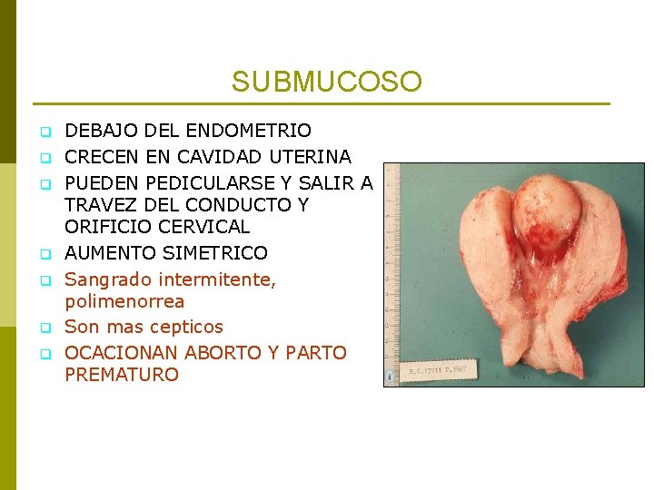 SUBMUCOSO q q q q DEBAJO DEL ENDOMETRIO CRECEN EN CAVIDAD UTERINA PUEDEN PEDICULARSE