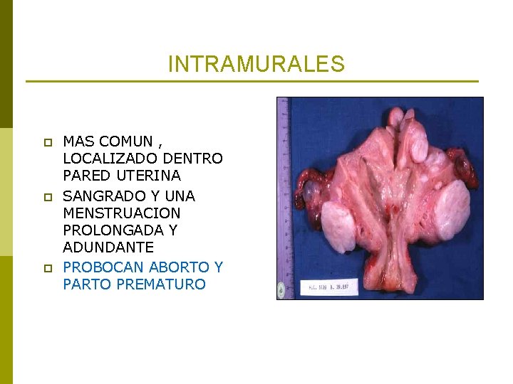 INTRAMURALES p p p MAS COMUN , LOCALIZADO DENTRO PARED UTERINA SANGRADO Y UNA