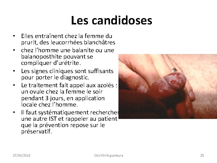 Les candidoses • Elles entraînent chez la femme du prurit, des leucorrhées blanchâtres •