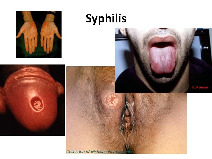 Syphilis 