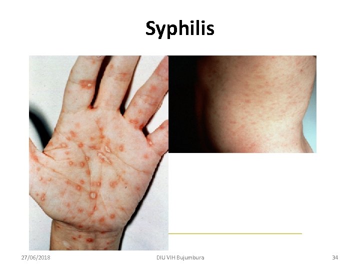 Syphilis 27/06/2018 DIU VIH Bujumbura 34 