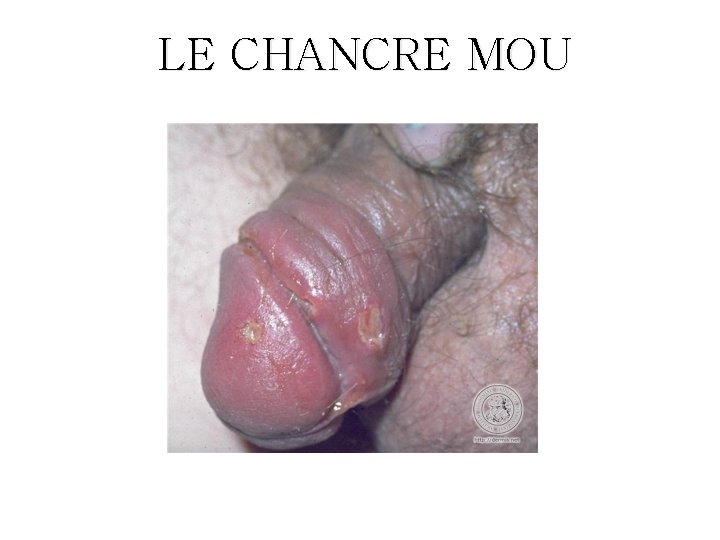 LE CHANCRE MOU 