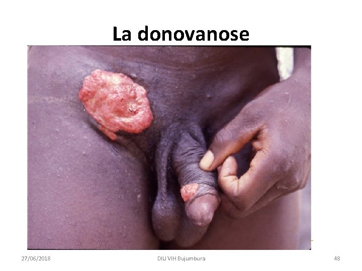 La donovanose 27/06/2018 DIU VIH Bujumbura 48 