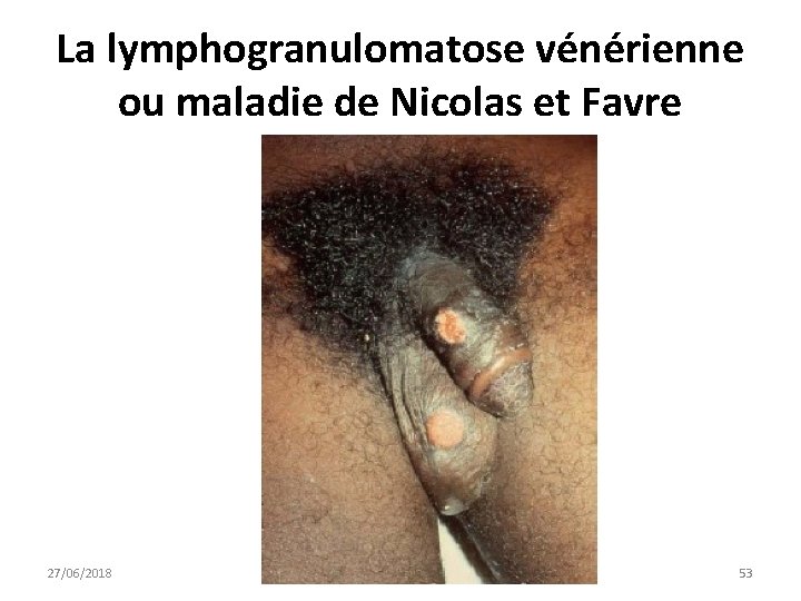 La lymphogranulomatose vénérienne ou maladie de Nicolas et Favre 27/06/2018 DIU VIH Bujumbura 53