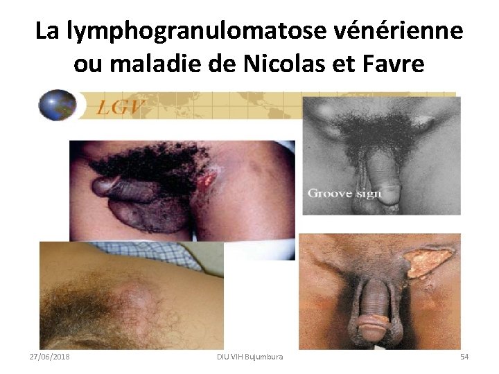 La lymphogranulomatose vénérienne ou maladie de Nicolas et Favre 27/06/2018 DIU VIH Bujumbura 54