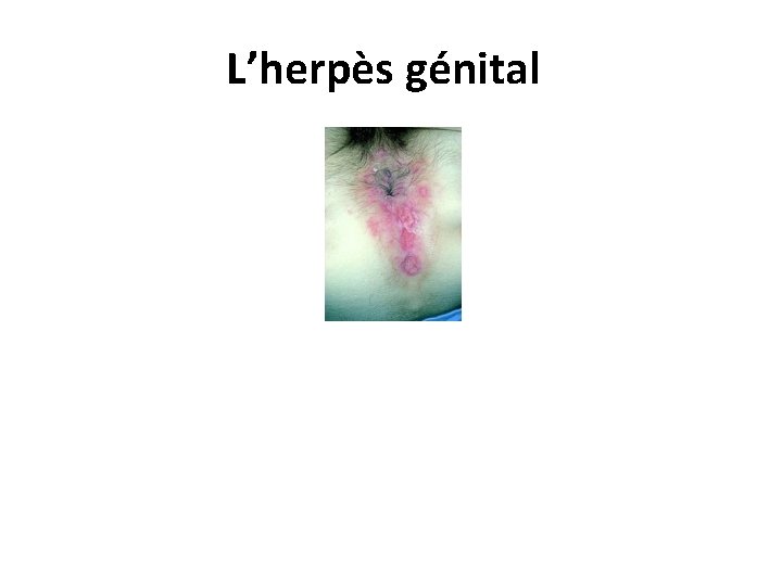 L’herpès génital 