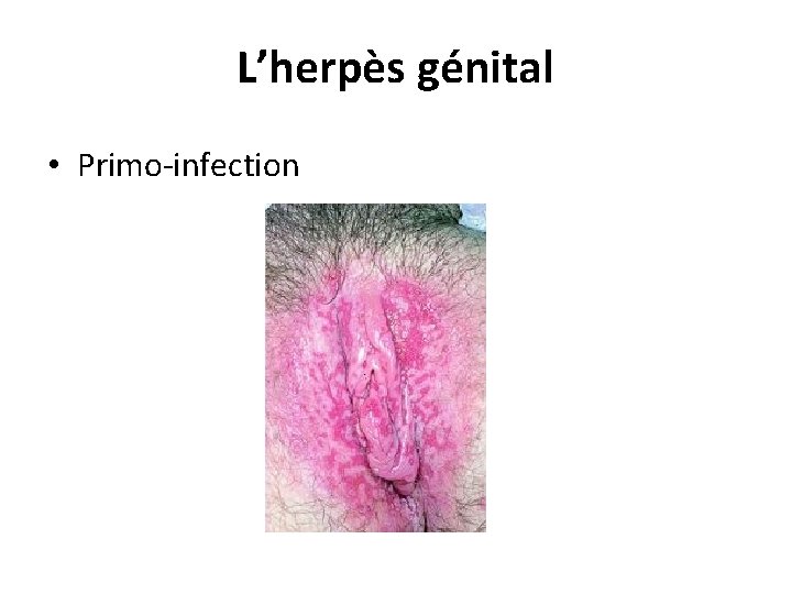 L’herpès génital • Primo-infection 