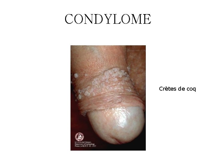 CONDYLOME Crètes de coq 