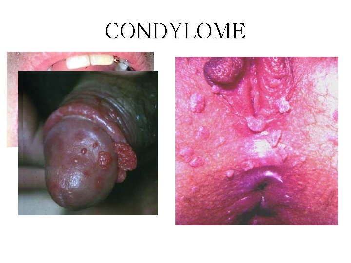 CONDYLOME 