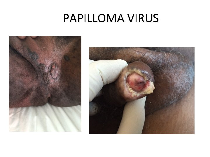 PAPILLOMA VIRUS 