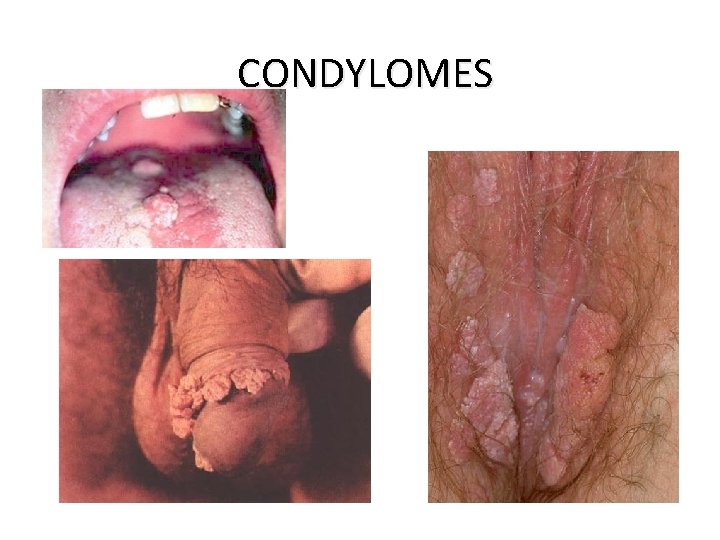 CONDYLOMES 