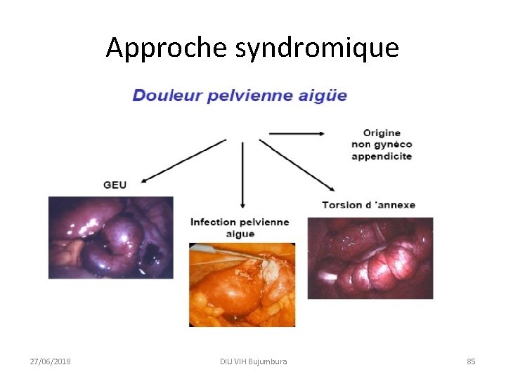 Approche syndromique 27/06/2018 DIU VIH Bujumbura 85 