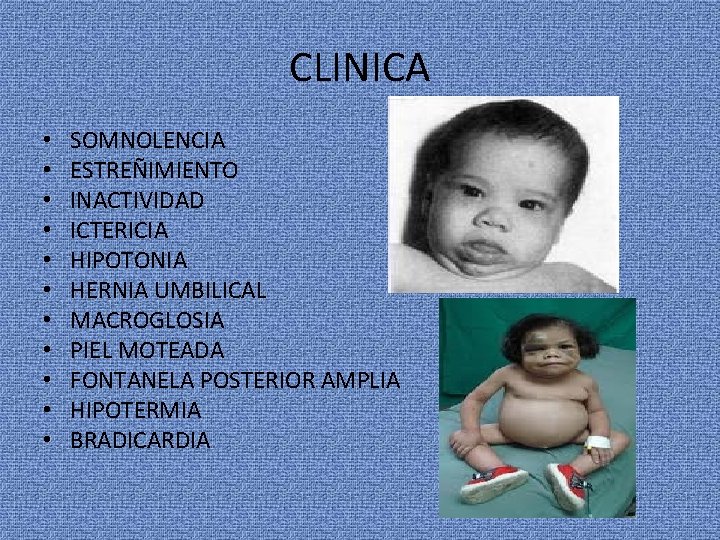 CLINICA • • • SOMNOLENCIA ESTREÑIMIENTO INACTIVIDAD ICTERICIA HIPOTONIA HERNIA UMBILICAL MACROGLOSIA PIEL MOTEADA
