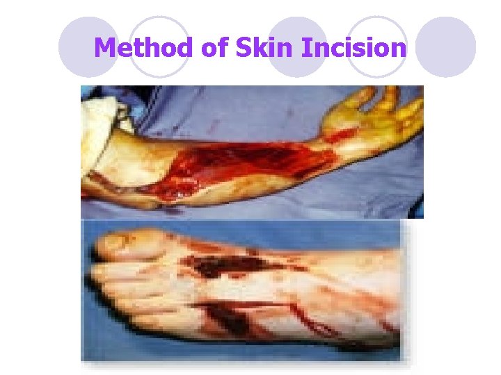 Method of Skin Incision 
