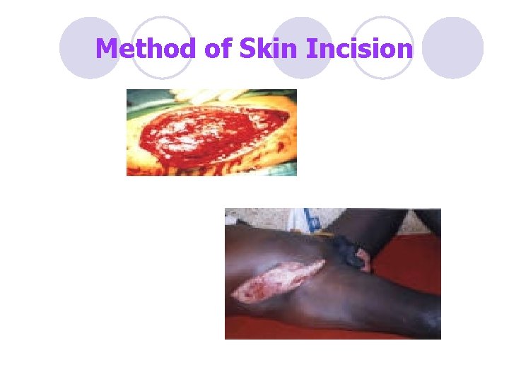 Method of Skin Incision 