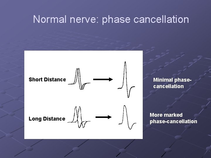Normal nerve: phase cancellation Short Distance Long Distance Minimal phasecancellation More marked phase-cancellation 