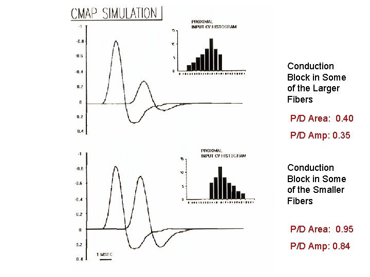 Conduction Block in Some of the Larger Fibers P/D Area: 0. 40 P/D Amp:
