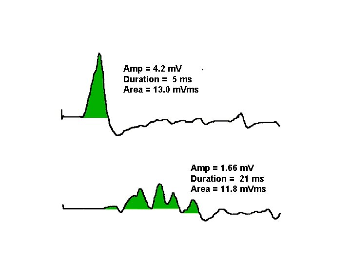 Amp = 4. 2 m. V Duration = 5 ms Area = 13. 0
