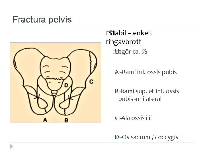 Fractura pelvis � Stabil � – enkelt ringavbrott �Utgör � ca. ⅔ �A �‐‐Rami