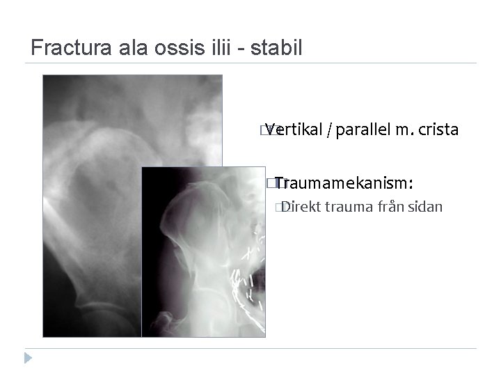 Fractura ala ossis ilii stabil � Vertikal � / parallel m. crista �Traumamekanism: �
