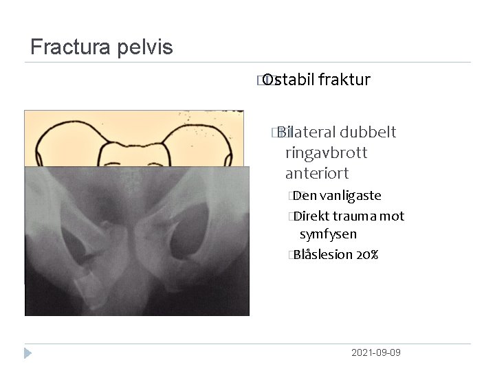 Fractura pelvis � Ostabil � fraktur �Bilateral � dubbelt ringavbrott anteriort � Den �