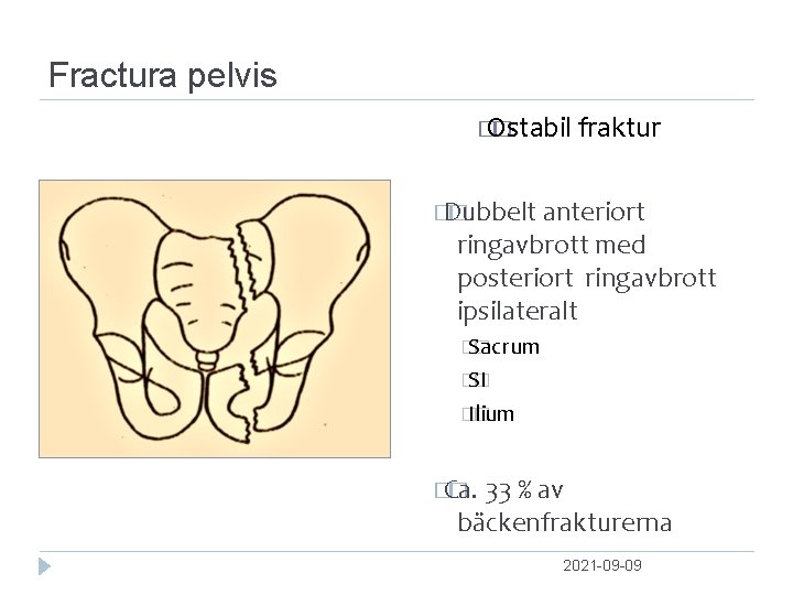 Fractura pelvis � Ostabil � fraktur �Dubbelt � anteriort ringavbrott med posteriort ringavbrott ipsilateralt