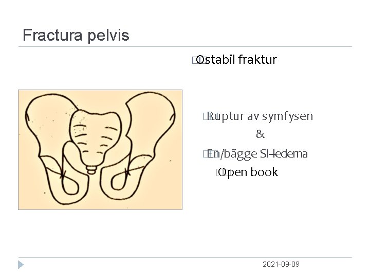 Fractura pelvis � Ostabil � fraktur � Ruptur � av symfysen & � En/bägge