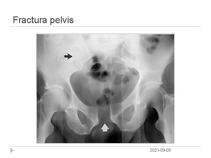 Fractura pelvis 2021 09 09 