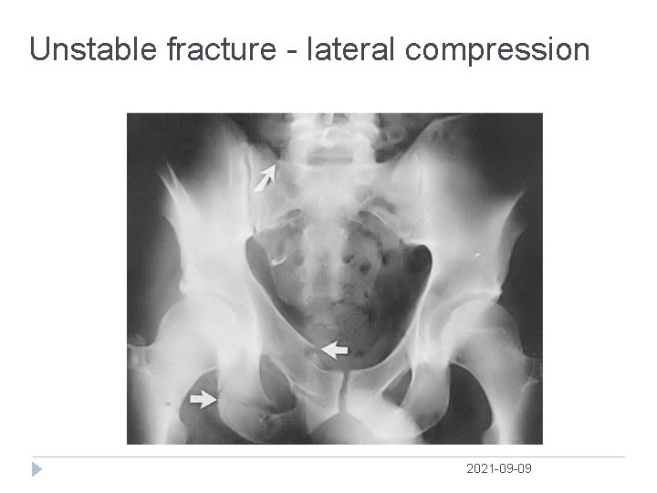 Unstable fracture lateral compression 2021 09 09 