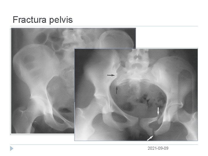 Fractura pelvis 2021 09 09 