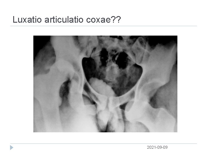 Luxatio articulatio coxae? ? 2021 09 09 
