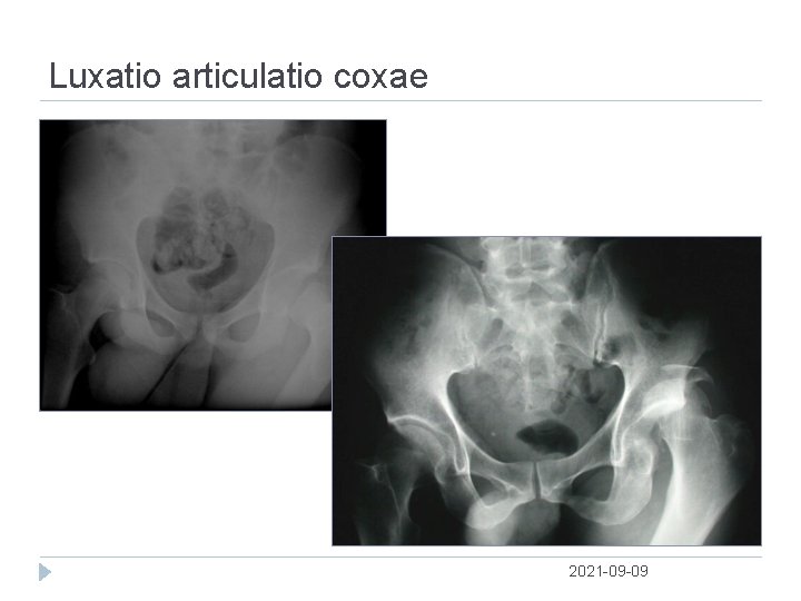 Luxatio articulatio coxae 2021 09 09 