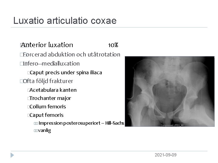 Luxatio articulatio coxae � Anterior � luxation 10% �Forcerad � abduktion och utåtrotation �Infero‐‐‐medial