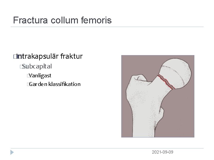 Fractura collum femoris � Intrakapsulär � fraktur �Subcapital � � Vanligast � �Garden �