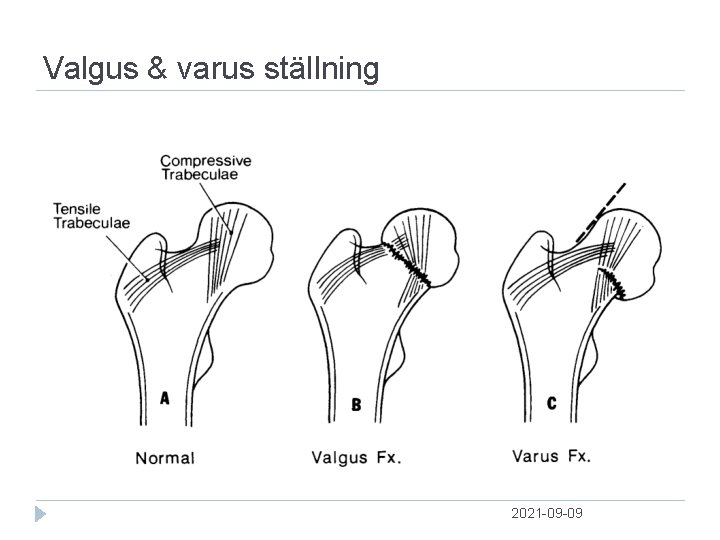 Valgus & varus ställning 2021 09 09 