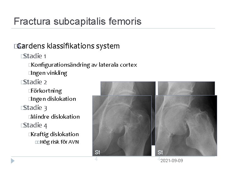 Fractura subcapitalis femoris � Gardens � klassiﬁkations system �Stadie � 1 �Konﬁgurationsändring � av