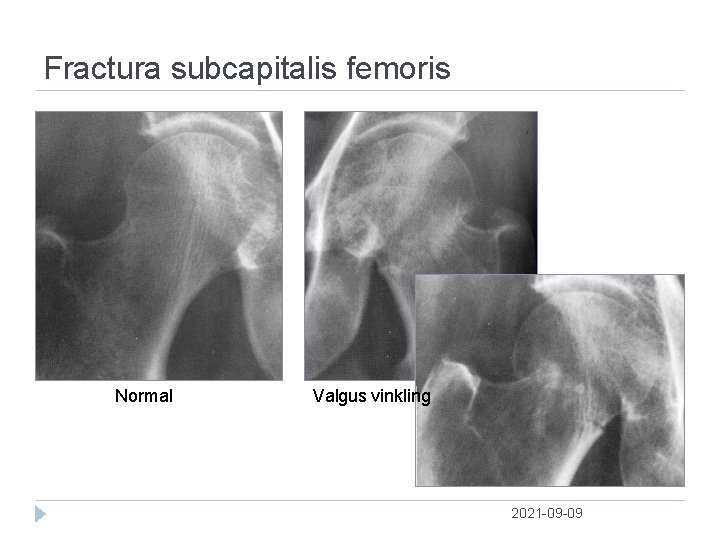 Fractura subcapitalis femoris Normal Valgus vinkling 2021 09 09 