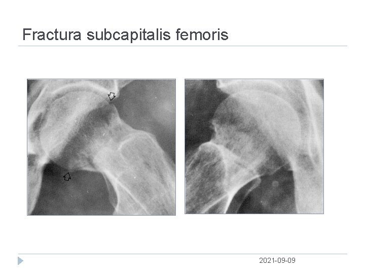Fractura subcapitalis femoris 2021 09 09 