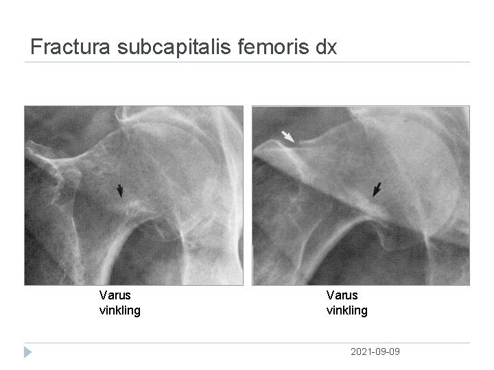 Fractura subcapitalis femoris dx Varus vinkling 2021 09 09 