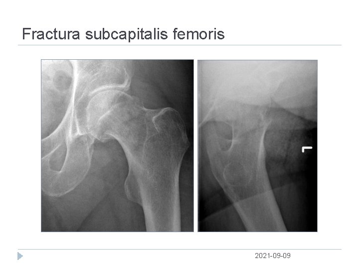 Fractura subcapitalis femoris 2021 09 09 