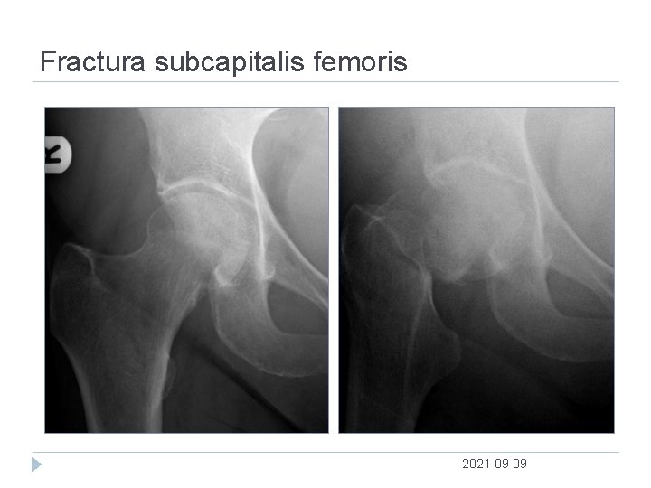 Fractura subcapitalis femoris 2021 09 09 