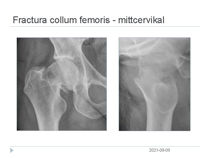 Fractura collum femoris mittcervikal 2021 09 09 