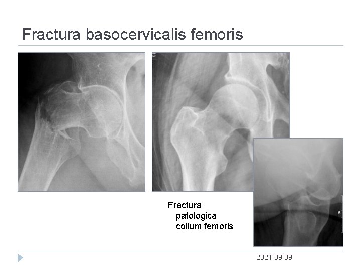 Fractura basocervicalis femoris Fractura patologica collum femoris 2021 09 09 