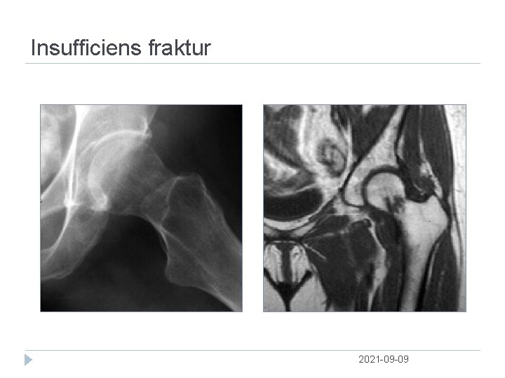 Insufficiens fraktur 2021 09 09 
