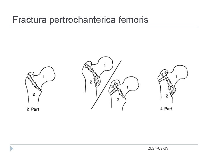 Fractura pertrochanterica femoris 2021 09 09 