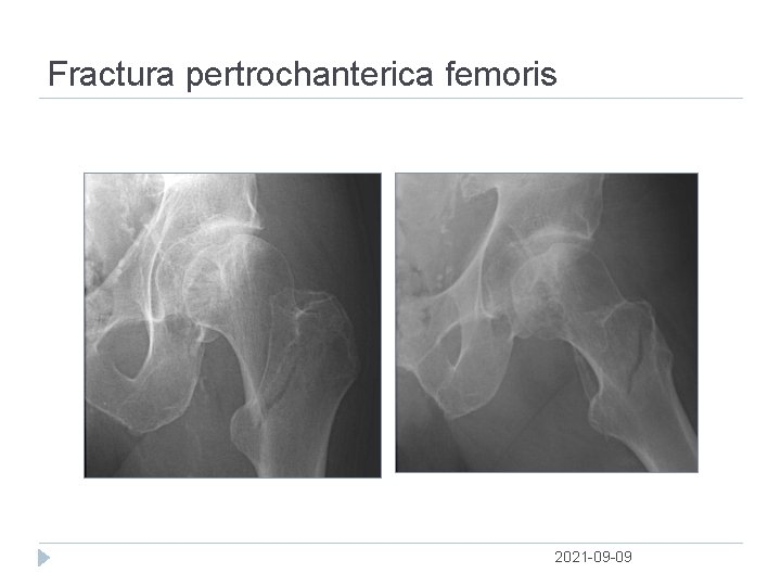 Fractura pertrochanterica femoris 2021 09 09 